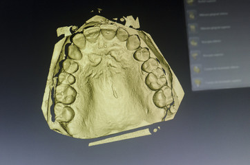 Dental technician is designing a dental crown with a computer.