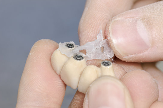 Dental technician applying shine of implant connection