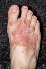 Disease of the skin on the foot - eczema.