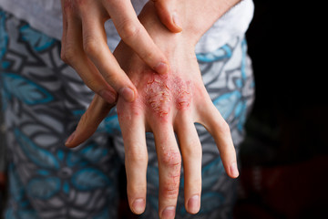 Closeup men itching and scratching by hand. Psoriasis or eczema on the hand. Atopic allergy skin with red spots