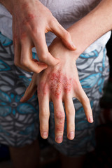 Closeup men itching and scratching by hand. Psoriasis or eczema on the hand. Atopic allergy skin with red spots - obrazy, fototapety, plakaty
