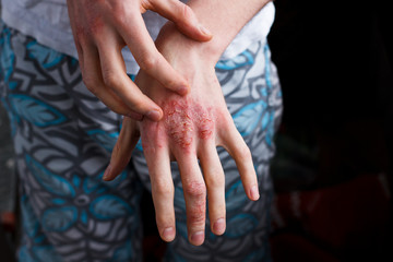 Closeup men itching and scratching by hand. Psoriasis or eczema on the hand. Atopic allergy skin...
