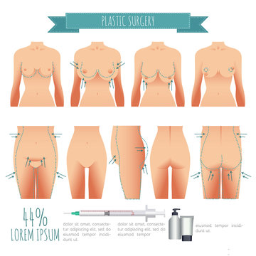 Plastic Surgery Illustrations. Breast Lift, Lipofilling, Abdominoplasty