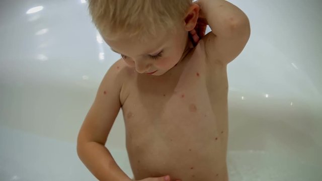 Baby boy is sitting in a bubble bath and he is touching his body. He looks very excited. He is having chickenpox.
