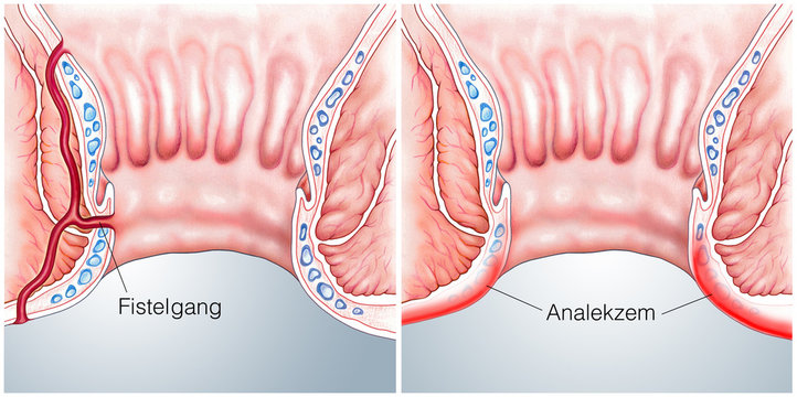 Analfistelgang.Juckendes Analekzem
