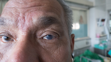 keratopathy bullous condition in eye of elderly patient