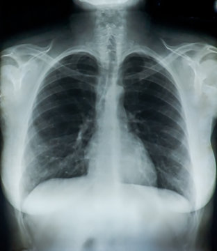 Xray of woman chest including her heart