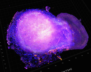 Transparent tumor tomography visualising tumor microenvironment, showing cytotoxic T cells attacking tumor after treatment