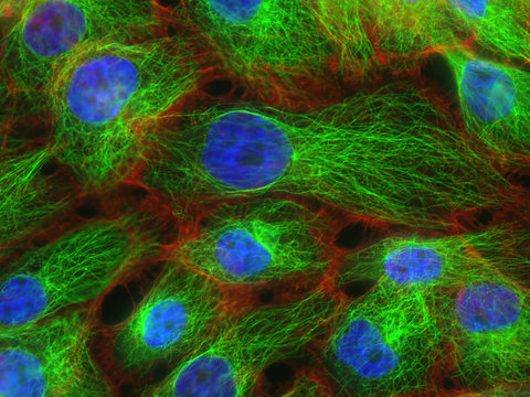 Fluorescence microscopy of stress fibers in breast cancer cells