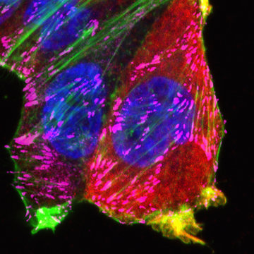 Enlarged focal adhesions in breast cancer cells