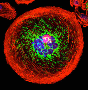 Microscopic image of polyploid giant cancer cell