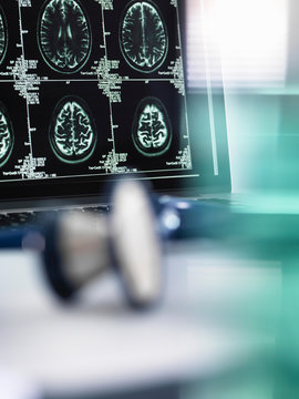 Series of MRI brain scans on computer screen with stethoscope in foreground on doctor's desk