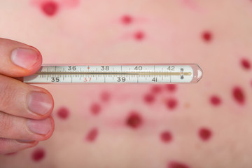 thermometer and chicken pox