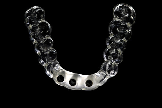splint for implant