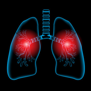 Lungs pain, Lungs x ray