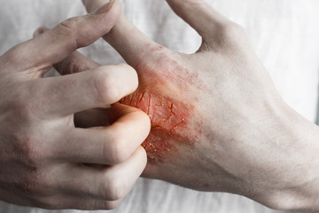 Pain red spot on man hand with eczema rash or allergy. Conceptual photo about healtcare and skin...