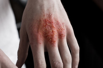 Pain red spot on man hand with eczema rash or allergy. Conceptual photo about healtcare and skin problems. Atopic psoriasis close up skin.