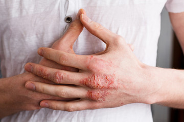 The problem with many people - eczema on hand. White background. Man itchind skin.