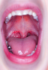 Obraz premium tonsilitis infection throat.macro opened mouth throat tonsil