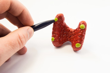 Parathyroid gland. Doctor or teacher of medical University or school points to anatomical location of parathyroid glands in model of thyroid gland. Concept for parathyroid diagnostics or treatment  