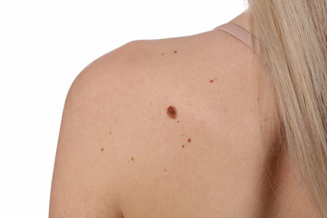 Young woman with birthmark on her back, skin isolated on white background. Checking benign moles. Skin tags removal concept
