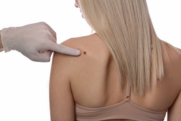 Doctor dermatologist examines birthmark of patient close up islolated on white background. Checking...