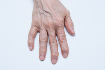 Osteoarthritis Hands and fingers of a female's hands.