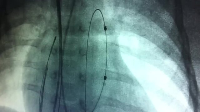 balloon dilatation of the pulmonary artery valve