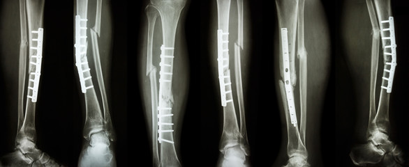Collection image of leg fracture and surgical treatment by internal fixation with plate and screw ....