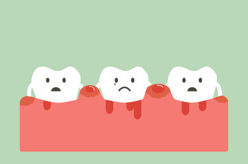 periodontitis and bleeding