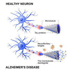 healthy cell and neurons with Alzheimer's disease. Tau hypothesis