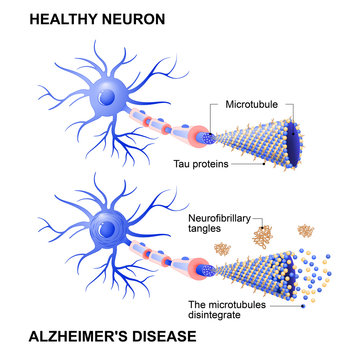 healthy cell and neurons with Alzheimer's disease. Tau hypothesis