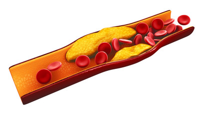 3d Illustration of blood cells with plaque buildup of cholesterol isolated white
