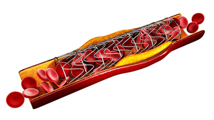 Stent implant concept as a heart disease treatment. 3D illustration. isolated white