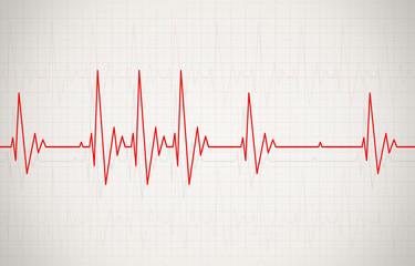 Irregular Heartbeat Illustration