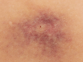 Fototapeta premium a bruise on the skin
