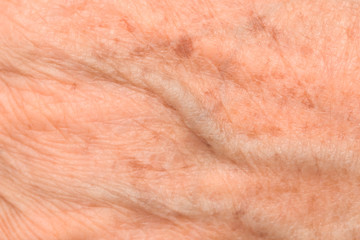 varicose veins on the skin