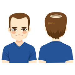 Illustration of bald man problem front and back view