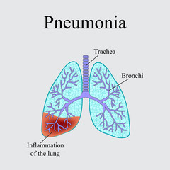 Pneumonia. The anatomical structure of the human lung. Vector illustration on a gray background