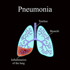 Pneumonia. The anatomical structure of the human lung. Vector illustration on a black background
