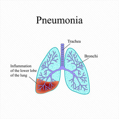 Pneumonia. The anatomical structure of the human lung. Inflammation of the lower lobe of the lung. Vector illustration