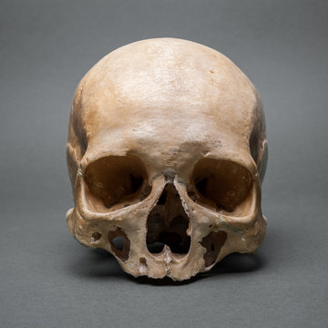skull without a jaw
