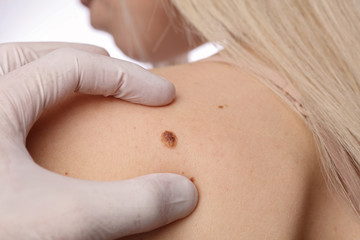 Doctor dermatologist examines birthmark of patient close up islolated on white background. Checking benign moles. Laser Skin tags removal - obrazy, fototapety, plakaty