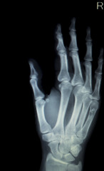 Hand fingers inury Xray scan