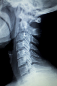 Spine neck Xray test scan