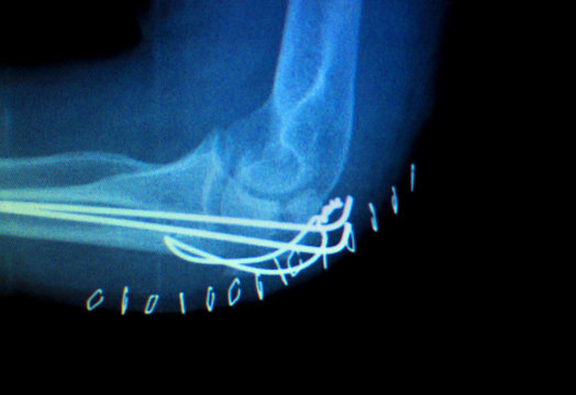 Elbow joint implant xray