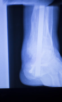 Xray foot heel ankle scan