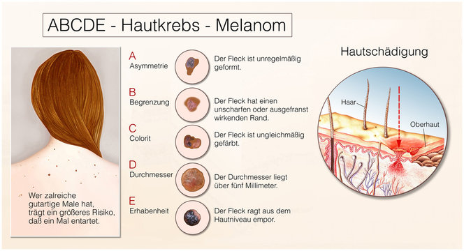 Hautkrebs.Melanom.ABCDE