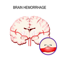 cerebral hemorrhage