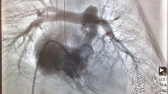 cardiac catheterization and great vessels
